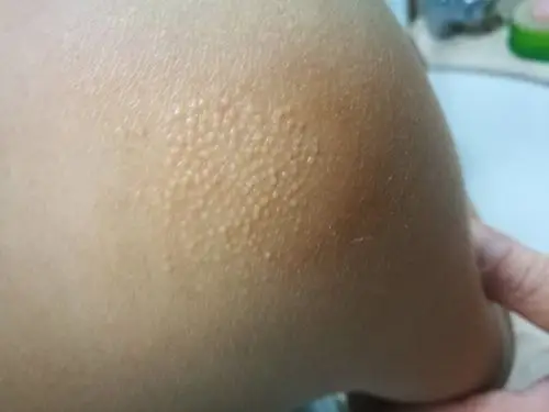 孩子肩膀外侧有这个疙瘩,哪位大神能知道?