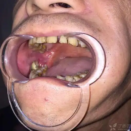 肿瘤侵及颊部皮肤 辅助检查:见图 临床诊断:右侧颊粘膜鳞状细胞癌