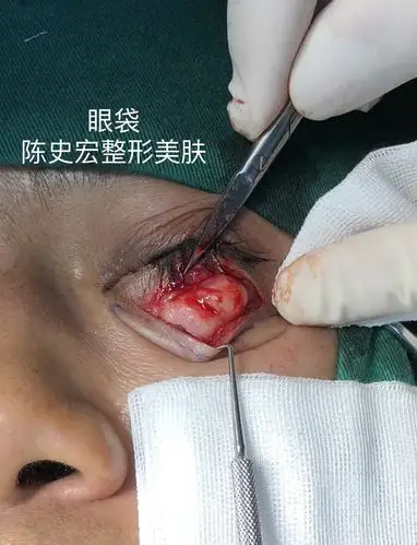 外路眼袋手术(去皮,去脂,眶隔释放,眼轮匝肌固定,卧蚕重建)