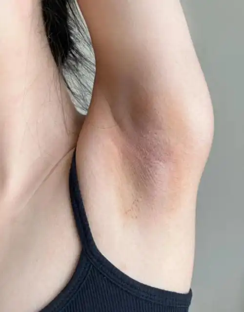 历经千辛万苦,我的狐臭症状终于减轻了不少,夏天也可以穿喜欢的衣服了