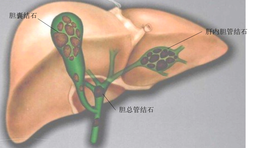 肝内胆管结石可以微创治疗吗 - 好大夫在线