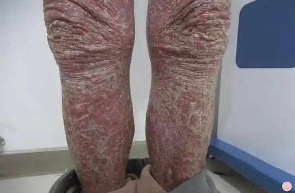 银屑病扶阳灸的功效 雷火灸可以治疗银屑病