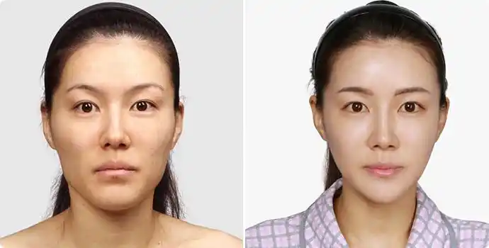 溶脂瘦脸前后对比图溶脂瘦脸效果图溶脂瘦脸前后对比照片