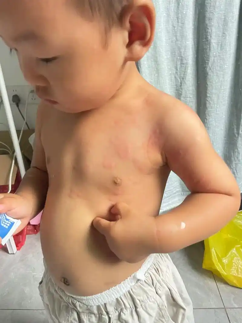 我想问问有没有人知道这是什么过敏.刚开始屁股抓烂了  全身长 - 抖音
