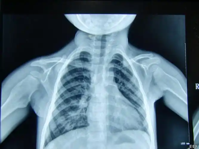 4﹎切开皮肤筋膜达瘤体部位,钝性分离瘤体表面软组织,见白色软骨帽,瘤