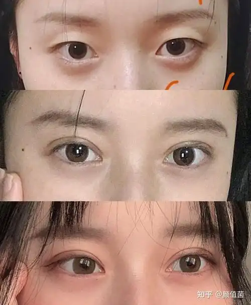 效果自然#的上海双眼皮/修复有tj的医生吗?不同基础附带案例解析