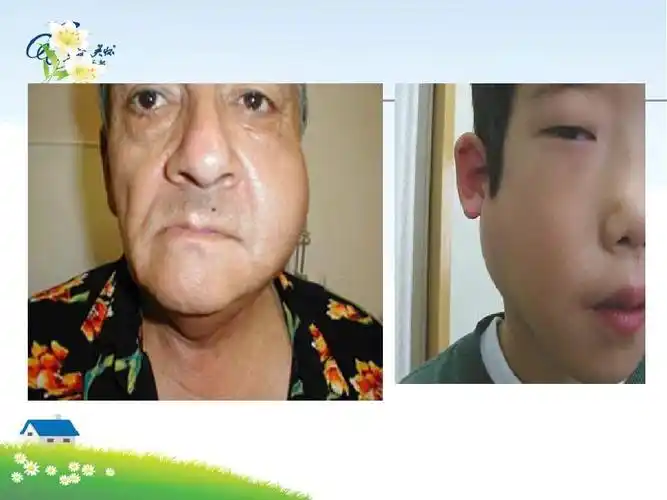 流行性腮腺炎课件ppt