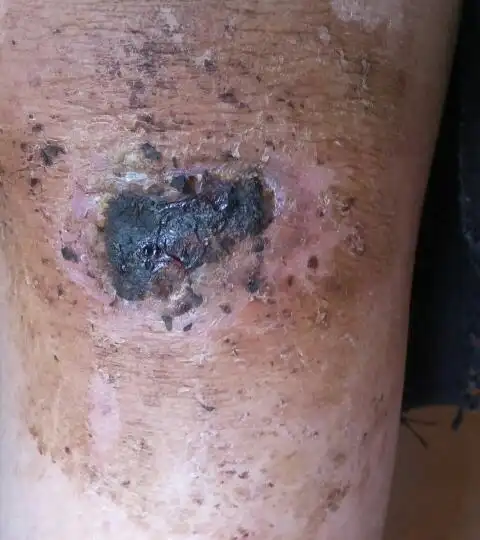 昨天有脓液流出现在外表干了,要不要撕掉一点痂引脓液出来,不撕的话脓