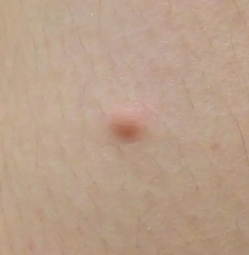 大腿内侧起了个小包,红色偏深.按下去会有些疼.长了有几个月了,没怎么