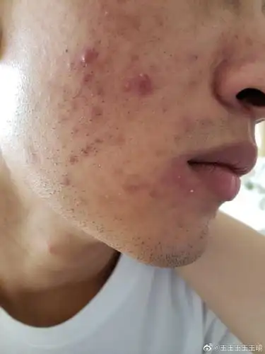青春期男生脸上长痘痘一直反复不好