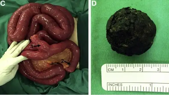 病例学习:胆石性肠梗阻合并 meckel 憩室 1 例