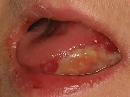 咽部肿瘤图片_咽部肿瘤症状表现图片大全_有来医生