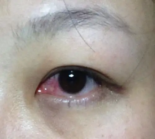 揉了眼睛,照镜子才发现有根睫毛并且眼睛非常红,回家后滴了氧氟沙星三