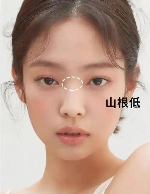 很多人的塌鼻梁伴随着低山根,山根过平的话眉眼间像缺了一块,显得眼距