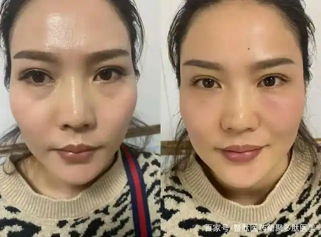 葡聚多肽干细胞填充产品安全吗