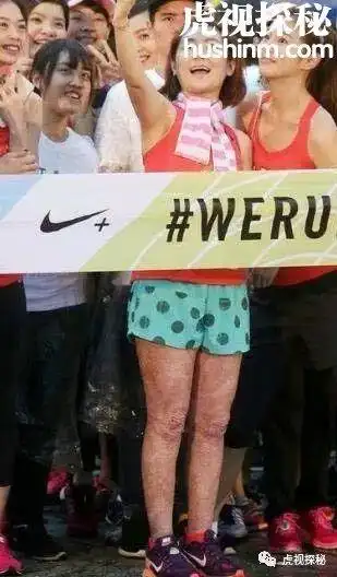 任家萱烧伤前后对比图片,满身伤疤触目惊心