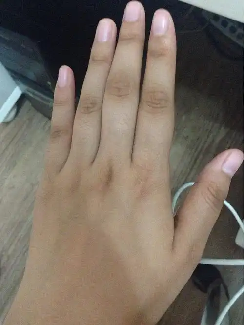 求救!手指关节发黑怎么办!