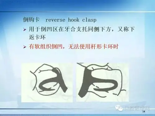 【多图】可摘局部义齿-卡环的种类