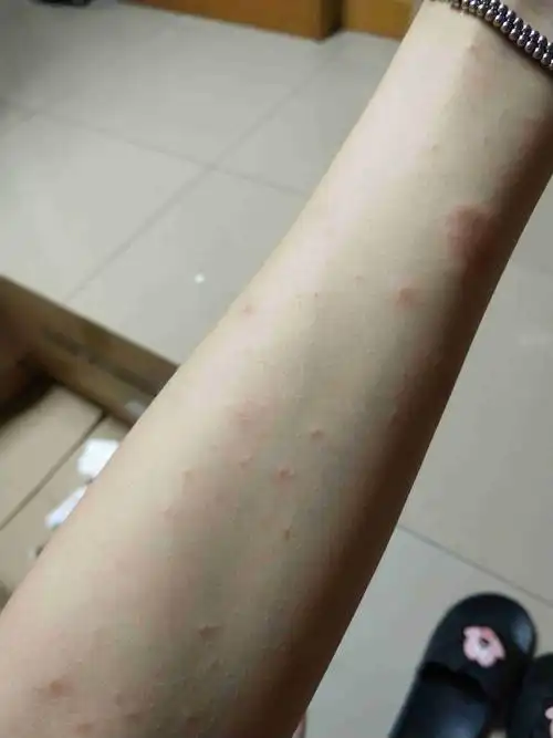 想问一下这是湿疹吗?