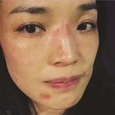 脸上过敏长"桃花癣" 舒淇"求分离"