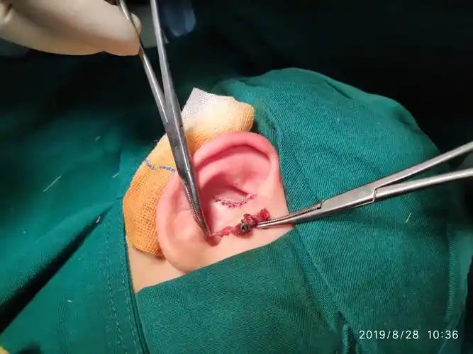 秦昊医生手记～复杂耳前瘘管切除 - 好大夫在线