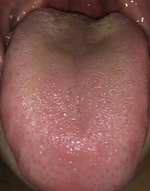 我舌头舌根这是怎么了?