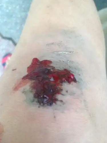 5 2011-09-26 膝盖摔伤怎么才会不留疤 33 2011-12-21 小时候膝盖上