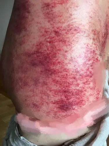 宫颈息肉及妇科炎症一次解决·刮痧