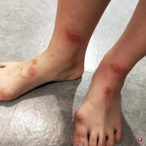 从霹雳搭长巴到新加坡 女子身上多处被臭虫咬至红肿
