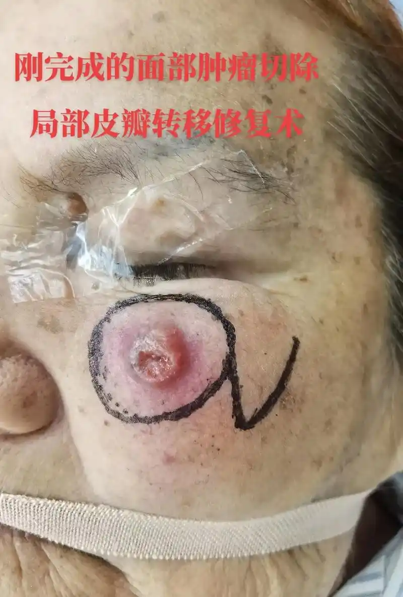 术后即刻刚完成的面部肿瘤切除面部肿瘤切除术局部皮局部皮瓣转移修复