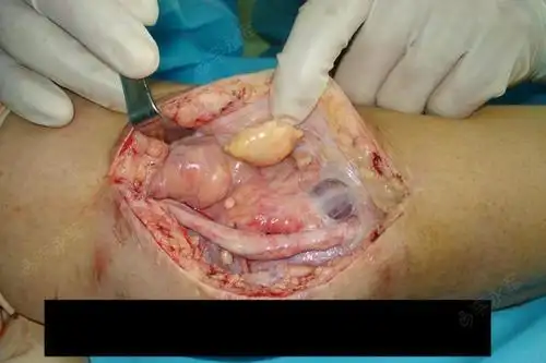 男45岁,肘管综合征术后迟发性伤口积液的治疗与预防