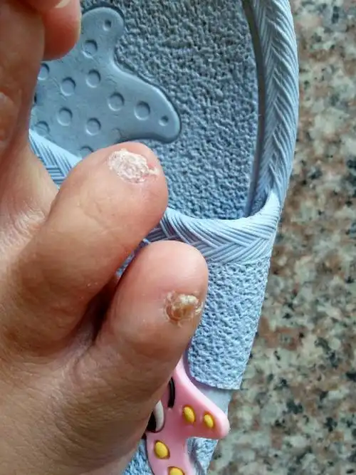 我的脚趾甲都变成白色粉末了,整个都变白了,是怎么回事,有人知道吗