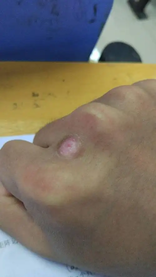 疣,十月一号做的冷冻,现在可以进行第二次冷冻治疗了吗