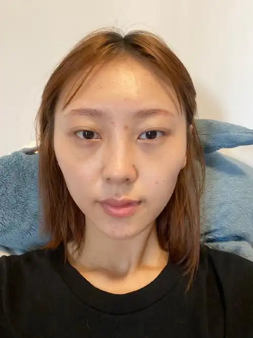 祛眼袋术后第7天.