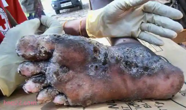 世界上十大最恶心的寄生虫 非常恶心恐怖