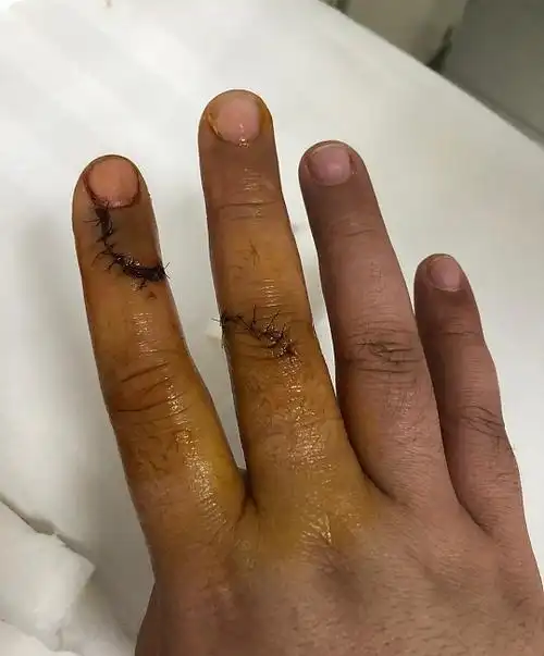 宝鸡一酒店洗漱盆破裂,割伤房客右手