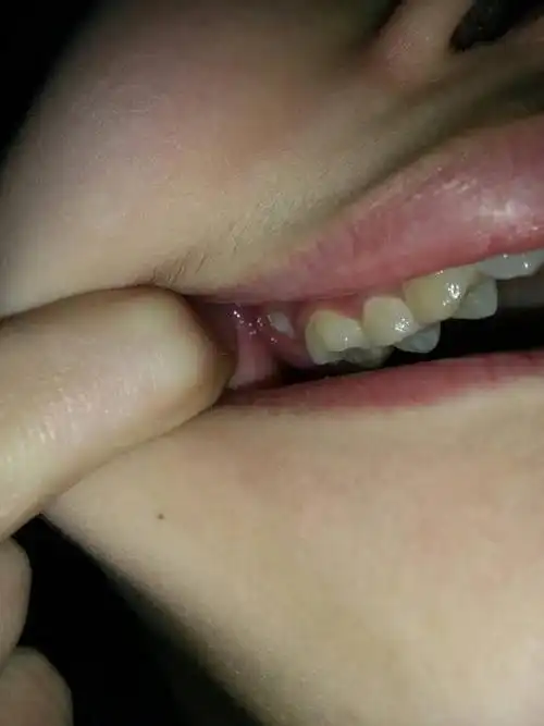 这种智齿位置可以不拔掉吗,不拔掉会怎样?女,14岁