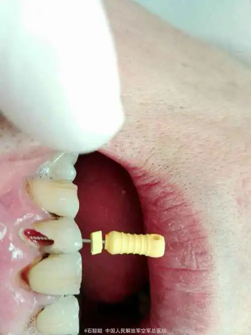 左上2急性根尖周炎