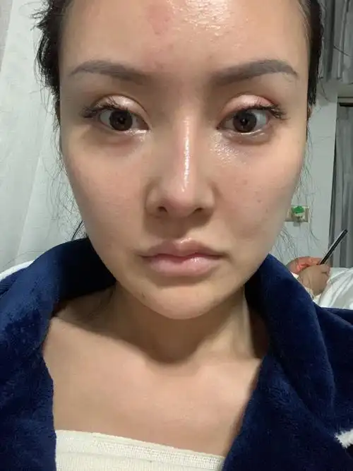 我想问一下我属于鼻基底凹陷吗法令纹我_新氧-专业医美服务平台