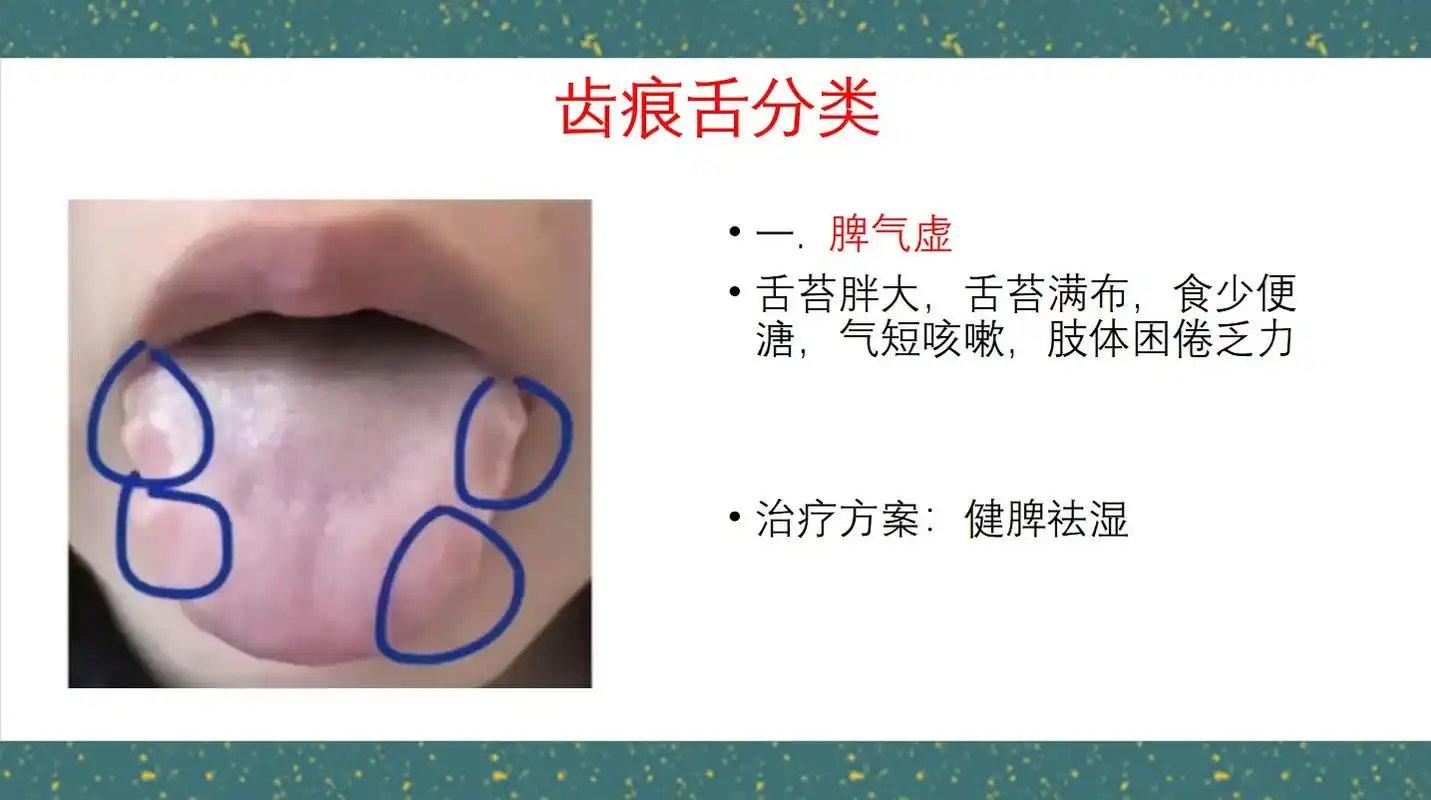 齿痕舌的几种类型#舌诊 - 抖音
