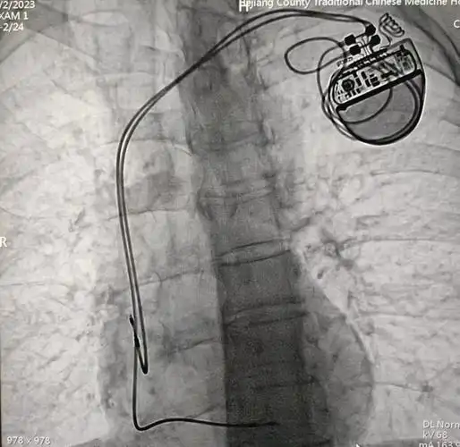 3例心脏人工永久双腔起搏器植入术成功开展