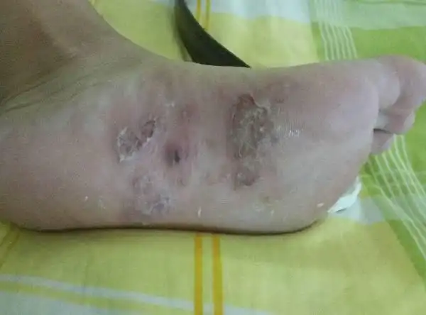 脚掌长水泡,然后就这样了,这是什么?可以走路?