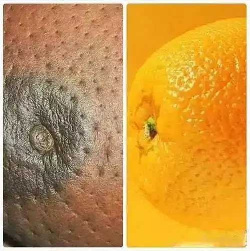 乳晕上的小疙瘩挤出白色的东西是怎么回事