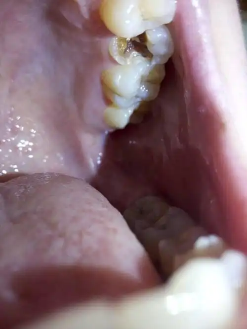 牙齿掉了一半 这颗牙齿我一年前因为痛去补过了 但是现在已经一年了