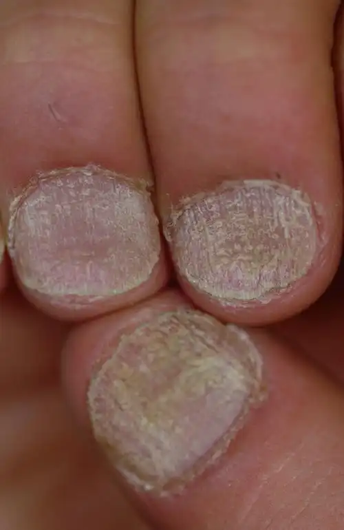 search results for: 指甲周围皱裂 - msd诊疗手册专业版