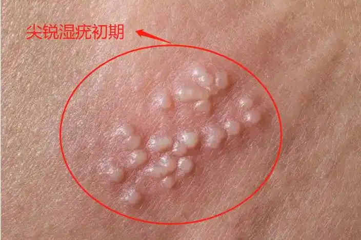女性早期尖锐湿疣