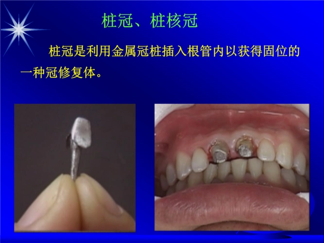 桩冠,桩核冠资料.ppt