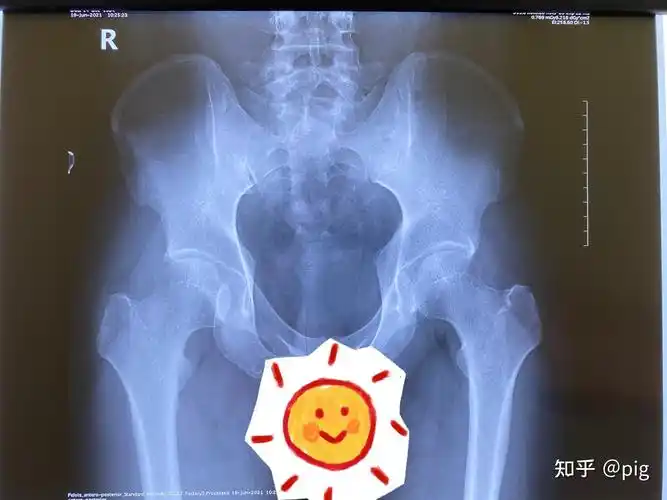 先天性髋关节发育不良71拜托拜托求解答