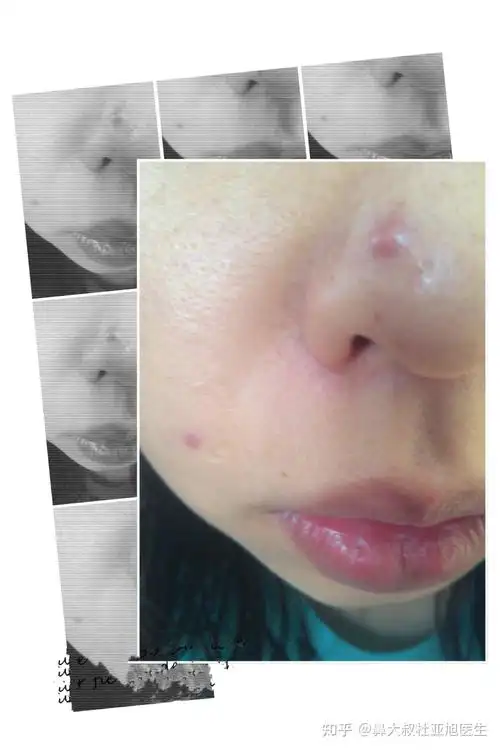 鼻子上长痘痘还能做隆鼻手术吗