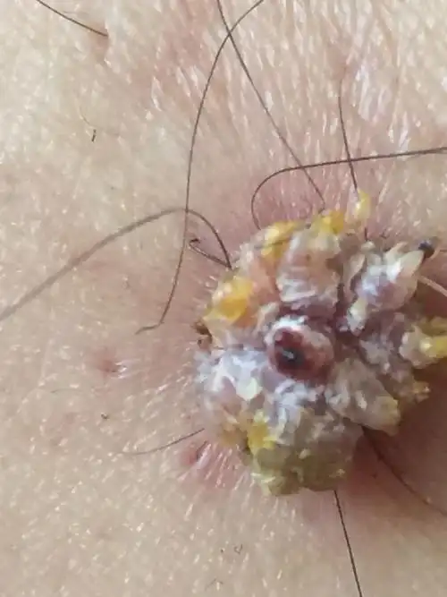 我小腿两个月前突然长出一个菜花状肉瘤,不痛不痒,就是感觉别扭,老师